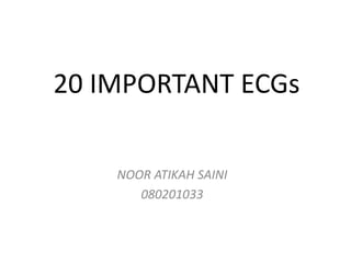 20 IMPORTANT ECGs

    NOOR ATIKAH SAINI
       080201033
 