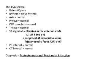 Ecg ! | PPTX