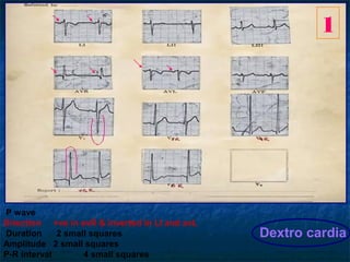 2




P wave
  Direction -ve in avR & +ve in LI and avL        Lowen Ganon Levin`s syndrome
Duration     2.5 small squares...