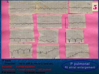 19




gradual prolongation of P-R interval until finally one QRS complex drop
… "one P wave not followed by QRS ” then th...