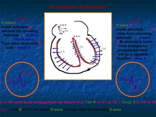 Lt ventricular enlargement
                  V1, V2                                            V5 , V6
Atrial depolarizati...
