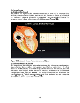 104
Arritmias lentas
a.- Bradicardia sinusal
Se produce por depresión del automatismo sinusal; la onda P y el complejo QRS
son de características normales, aunque con una frecuencia menor de 60 latidos
por minuto. Es frecuente en jóvenes y deportistas, y se debe a hipertono vagal. En
ancianos puede indicar enfermedad del nódulo sinusal (Figura 138).
Figura 138 Bradicardia sinusal. Frecuencia menor de 60 lpm.
b.- Impulso y ritmo de escape
En situación de depresión del automatismo sinusal, las estructuras cardíacas con
automatismo, denominadas marcapasos subsidiarios, determinan el ritmo
cardíaco. Habitualmente es el nodo el que toma el mando del corazón, con una
frecuencia entre 40 y 60 latidos por minuto, debido a la velocidad de su pendiente
de despolarización diastólica (Figura 139). Si éste también fracasa, suelen ser las
ramificaciones de Purkinje las que mantienen el ritmo cardíaco, con una frecuencia
entre 20 y 30 latidos por minuto (Figura 140).
 