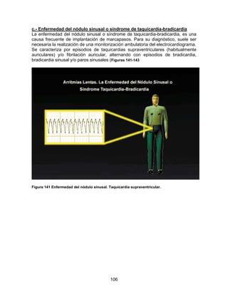 106
c.- Enfermedad del nódulo sinusal o síndrome de taquicardia-bradicardia
La enfermedad del nódulo sinusal o síndrome de taquicardia-bradicardia, es una
causa frecuente de implantación de marcapasos. Para su diagnóstico, suele ser
necesaria la realización de una monitorización ambulatoria del electrocardiograma.
Se caracteriza por episodios de taquicardias supraventriculares (habitualmente
auriculares) y/o fibrilación auricular, alternando con episodios de bradicardia,
bradicardia sinusal y/o paros sinusales (Figuras 141-143
Figura 141 Enfermedad del nódulo sinusal. Taquicardia supraventricular.
 