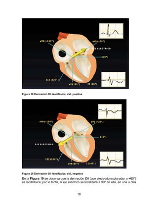 18
Figura 19 Derivación DII isodifásica; aVL positiva
Figura 20 Derivación DII isodifásica; aVL negativa
En la Figura 19 se observa que la derivación DII (con electrodo explorador a +60°)
es isodifásica; por lo tanto, el eje eléctrico se localizará a 90° de ella, en una u otra
 