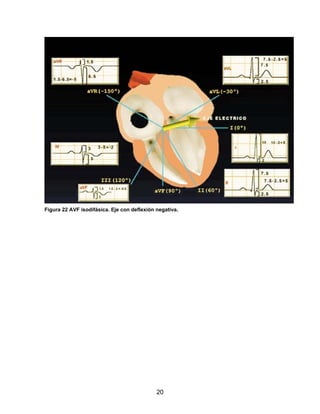 20
Figura 22 AVF isodifásica. Eje con deflexión negativa.
 