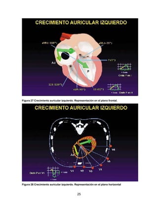 25
Figura 27 Crecimiento auricular izquierdo. Representación en el plano frontal.
Figura 28 Crecimiento auricular izquierdo. Representación en el plano horizontal
 