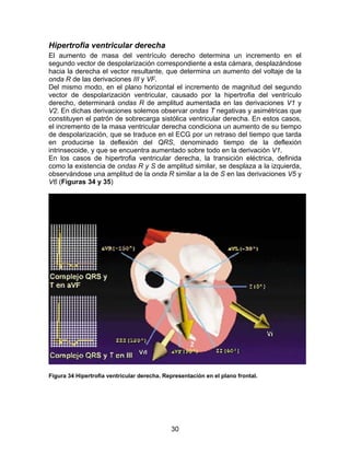 30
Hipertrofia ventricular derecha
El aumento de masa del ventrículo derecho determina un incremento en el
segundo vector de despolarización correspondiente a esta cámara, desplazándose
hacia la derecha el vector resultante, que determina un aumento del voltaje de la
onda R de las derivaciones III y VF.
Del mismo modo, en el plano horizontal el incremento de magnitud del segundo
vector de despolarización ventricular, causado por la hipertrofia del ventrículo
derecho, determinará ondas R de amplitud aumentada en las derivaciones V1 y
V2. En dichas derivaciones solemos observar ondas T negativas y asimétricas que
constituyen el patrón de sobrecarga sistólica ventricular derecha. En estos casos,
el incremento de la masa ventricular derecha condiciona un aumento de su tiempo
de despolarización, que se traduce en el ECG por un retraso del tiempo que tarda
en producirse la deflexión del QRS, denominado tiempo de la deflexión
intrinsecoide, y que se encuentra aumentado sobre todo en la derivación V1.
En los casos de hipertrofia ventricular derecha, la transición eléctrica, definida
como la existencia de ondas R y S de amplitud similar, se desplaza a la izquierda,
observándose una amplitud de la onda R similar a la de S en las derivaciones V5 y
V6 (Figuras 34 y 35)
Figura 34 Hipertrofia ventricular derecha. Representación en el plano frontal.
 