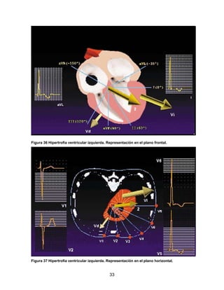 33
Figura 36 Hipertrofia ventricular izquierda. Representación en el plano frontal.
Figura 37 Hipertrofia ventricular izquierda. Representación en el plano horizontal.
 