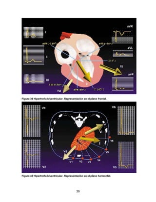 36
Figura 39 Hipertrofia biventricular. Representación en el plano frontal.
Figura 40 Hipertrofia biventricular. Representación en el plano horizontal.
 
