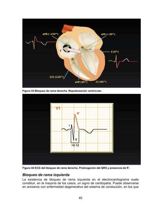 40
Figura 43 Bloqueo de rama derecha. Repolarización ventricular.
Figura 44 ECG del bloqueo de rama derecha. Prolongación del QRS y presencia de R’.
Bloqueo de rama izquierda
La existencia de bloqueo de rama izquierda en el electrocardiograma suele
constituir, en la mayoría de los casos, un signo de cardiopatía. Puede observarse
en ancianos con enfermedad degenerativa del sistema de conducción, en los que
 