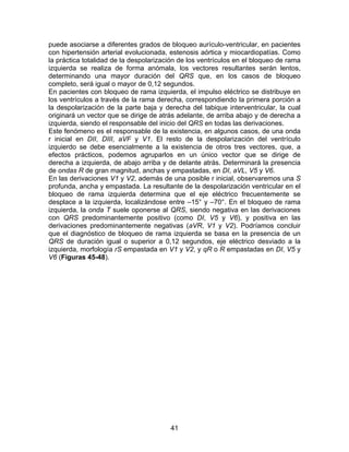 41
puede asociarse a diferentes grados de bloqueo aurículo-ventricular, en pacientes
con hipertensión arterial evolucionada, estenosis aórtica y miocardiopatías. Como
la práctica totalidad de la despolarización de los ventrículos en el bloqueo de rama
izquierda se realiza de forma anómala, los vectores resultantes serán lentos,
determinando una mayor duración del QRS que, en los casos de bloqueo
completo, será igual o mayor de 0,12 segundos.
En pacientes con bloqueo de rama izquierda, el impulso eléctrico se distribuye en
los ventrículos a través de la rama derecha, correspondiendo la primera porción a
la despolarización de la parte baja y derecha del tabique interventricular, la cual
originará un vector que se dirige de atrás adelante, de arriba abajo y de derecha a
izquierda, siendo el responsable del inicio del QRS en todas las derivaciones.
Este fenómeno es el responsable de la existencia, en algunos casos, de una onda
r inicial en DII, DIII, aVF y V1. El resto de la despolarización del ventrículo
izquierdo se debe esencialmente a la existencia de otros tres vectores, que, a
efectos prácticos, podemos agruparlos en un único vector que se dirige de
derecha a izquierda, de abajo arriba y de delante atrás. Determinará la presencia
de ondas R de gran magnitud, anchas y empastadas, en DI, aVL, V5 y V6.
En las derivaciones V1 y V2, además de una posible r inicial, observaremos una S
profunda, ancha y empastada. La resultante de la despolarización ventricular en el
bloqueo de rama izquierda determina que el eje eléctrico frecuentemente se
desplace a la izquierda, localizándose entre –15° y –70°. En el bloqueo de rama
izquierda, la onda T suele oponerse al QRS, siendo negativa en las derivaciones
con QRS predominantemente positivo (como DI, V5 y V6), y positiva en las
derivaciones predominantemente negativas (aVR, V1 y V2). Podríamos concluir
que el diagnóstico de bloqueo de rama izquierda se basa en la presencia de un
QRS de duración igual o superior a 0,12 segundos, eje eléctrico desviado a la
izquierda, morfología rS empastada en V1 y V2, y qR o R empastadas en DI, V5 y
V6 (Figuras 45-48).
 
