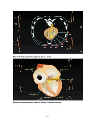 42
Figura 45 Bloqueo de rama izquierda. Onda r inicial.
Figura 46 Bloqueo de rama izquierda. Ondas R de gran magnitud.
 
