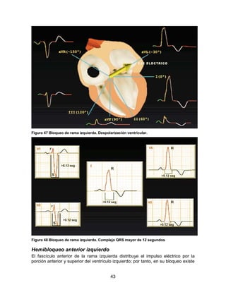 43
Figura 47 Bloqueo de rama izquierda. Despolarización ventricular.
Figura 48 Bloqueo de rama izquierda. Complejo QRS mayor de 12 segundos
Hemibloqueo anterior izquierdo
El fascículo anterior de la rama izquierda distribuye el impulso eléctrico por la
porción anterior y superior del ventrículo izquierdo; por tanto, en su bloqueo existe
 