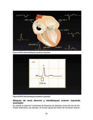 47
Figura 53 ECG del hemibloqueo posterior izquierdo.
Figura 54 ECG del hemibloqueo posterior izquierdo
Bloqueo de rama derecha y hemibloqueo anterior izquierdo
asociados
Es posible la aparición combinada de bloqueos de distintas zonas del haz de His.
Puede observarse, por ejemplo, en la fase aguda del infarto de miocardio anterior,
 