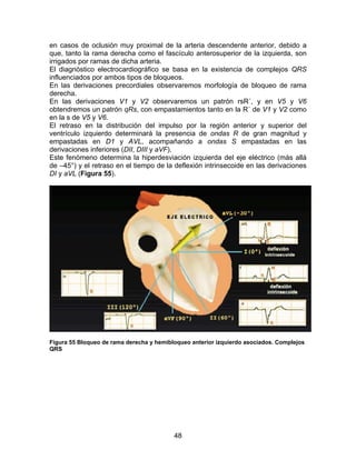 48
en casos de oclusión muy proximal de la arteria descendente anterior, debido a
que, tanto la rama derecha como el fascículo anterosuperior de la izquierda, son
irrigados por ramas de dicha arteria.
El diagnóstico electrocardiográfico se basa en la existencia de complejos QRS
influenciados por ambos tipos de bloqueos.
En las derivaciones precordiales observaremos morfología de bloqueo de rama
derecha.
En las derivaciones V1 y V2 observaremos un patrón rsR´, y en V5 y V6
obtendremos un patrón qRs, con empastamientos tanto en la R´ de V1 y V2 como
en la s de V5 y V6.
El retraso en la distribución del impulso por la región anterior y superior del
ventrículo izquierdo determinará la presencia de ondas R de gran magnitud y
empastadas en D1 y AVL, acompañando a ondas S empastadas en las
derivaciones inferiores (DII, DIII y aVF).
Este fenómeno determina la hiperdesviación izquierda del eje eléctrico (más allá
de –45°) y el retraso en el tiempo de la deflexión intrinsecoide en las derivaciones
DI y aVL (Figura 55).
Figura 55 Bloqueo de rama derecha y hemibloqueo anterior izquierdo asociados. Complejos
QRS
 