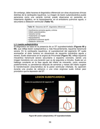 59
Sin embargo, debe hacerse el diagnóstico diferencial con otras situaciones clínicas
distintas de la cardiopatía isquémica. La imagen de lesión subendocárdica puede
apreciarse como una variante normal; puede observarse en pacientes en
tratamiento digitálico, en la hipopotasemia, en el embolismo pulmonar agudo, o
secundaria a dilatación ventricular (Tabla 10).
Tabla 10.- Descenso del ST, diagnóstico diferencial
• Insuficiencia coronaria aguda y crónica
• Infarto subendocárdico
• Variante normal
• Tratamiento con digital
• Hipopotasemia
• Embolismo pulmonar agudo
• Dilatación ventricular
b.2- Lesión subepicárdica
El diagnóstico se basa en la presencia de un ST supradesnivelado (Figuras 68 y
69), que refleja lesión subepicárdica o, más frecuentemente, isquemia transmural
severa. En la cardiopatía isquémica, el supradesnivel del segmento ST suele
acompañar al dolor torácico en situaciones de isquemia miocárdica aguda y
severa. Suele observarse en la angina de Prinzmetal (Figura 70); refleja isquemia
miocárdica transmural severa secundaria a espasmo coronario, siendo una
imagen transitoria con una duración que va de segundos a minutos. Suele ser un
hallazgo constante en la fase aguda del infarto de miocardio, como veremos
posteriormente; su persistencia después de semanas y meses del infarto sugiere
la transformación aneurismática de la pared ventricular infartada. Su aparición
durante una prueba de esfuerzo o una crisis anginosa suele indicar peor
pronóstico que la depresión del ST.
Figura 68 Lesión subepicárdica. ST supradesnivelado
 