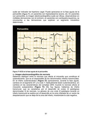 61
suele ser indicador de hipertono vagal. Puede apreciarse en la fase aguda de la
pericarditis (Figura 71), en pacientes con hiperpotasemia severa, etc. En pacientes
con pericarditis, la imagen electrocardiográfica suele ser difusa, observándose en
múltiples derivaciones; por el contrario, en pacientes con cardiopatía isquémica, se
circunscribe a las derivaciones que exploran un segmento miocárdico
determinado.
Figura 71 ECG en la fase aguda de la pericarditis
c.- Imagen electrocardiográfica de necrosis
Debemos distinguir entre la necrosis que afecta al miocardio que constituye el
subendocardio, que es el responsable de los denominados infartos transmurales.
En el infarto subendocárdico (Figura 72) apreciaremos, durante la fase aguda,
cambios en el segmento ST y la onda T, habitualmente lesión subendocárdica, sin
cambios en las características del complejo QRS. Cuando la necrosis afecta al
miocardio subepicárdico (Figura 73) (No hay figura), hablamos de infarto
transmural, que se caracteriza por el desarrollo de ondas Q patológicas
denominadas Q de necrosis. La génesis de una onda Q patológica durante un
infarto transmural se explica por el desarrollo en la zona infartada de un vector de
despolarización que se aleja de la zona del infarto, mostrándole la cola negativa.
 