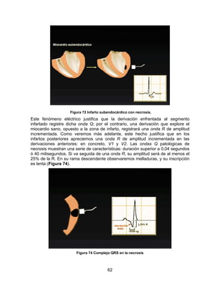 62
Figura 72 Infarto subendocárdico con necrosis. 73
Este fenómeno eléctrico justifica que la derivación enfrentada al segmento
infartado registre dicha onda Q; por el contrario, una derivación que explore el
miocardio sano, opuesto a la zona de infarto, registrará una onda R de amplitud
incrementada. Como veremos más adelante, este hecho justifica que en los
infartos posteriores apreciemos una onda R de amplitud incrementada en las
derivaciones anteriores: en concreto, V1 y V2. Las ondas Q patológicas de
necrosis muestran una serie de características: duración superior a 0,04 segundos
ó 40 milisegundos. Si va seguida de una onda R, su amplitud será de al menos el
25% de la R. En su rama descendente observaremos melladuras, y su inscripción
es lenta (Figura 74).
Figura 74 Complejo QRS en la necrosis
 