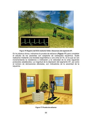 64
Figura 76 Registro del ECG mediante Holter. Descensos del segmento ST.
En la práctica clínica, indicamos la prueba de esfuerzo (Figura 77) para completar
el estudio de los pacientes con sospecha de cardiopatía isquémica. Suele
realizarse mediante una bicicleta ergométrica o una cinta sin fin, en la que se van
incrementando la resistencia o inclinación y la velocidad de la cinta siguiendo
protocolos establecidos. La magnitud de la depresión del segmento ST, así como
el número de derivaciones afectadas, son indicadores de la severidad de la
isquemia.
Figura 77 Prueba de esfuerzo
 