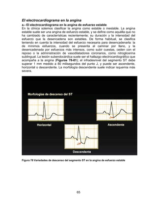 65
El electrocardiograma en la angina
a.- El electrocardiograma en la angina de esfuerzo estable
En la clínica solemos clasificar la angina como estable o inestable. La angina
estable suele ser una angina de esfuerzo estable, y se define como aquélla que no
ha cambiado de características recientemente; su duración y la intensidad del
esfuerzo que la desencadena son estables. De forma habitual, se clasifica
teniendo en cuenta la intensidad del esfuerzo necesaria para desencadenarla: la
de mínimos esfuerzos, cuando se presenta al caminar por llano, y la
desencadenada por esfuerzos más intensos, como subir cuestas, ceden con el
reposo o la administración de vasodilatadores coronarios, como nitroglicerina
sublingual. La lesión subendocárdica suele ser el hallazgo electrocardiográfico que
acompaña a la angina (Figuras 78-81); el infradesnivel del segmento ST debe
superar 1 mm medido a 80 milisegundos del punto J, y puede ser ascendente,
horizontal o descendente. La morfología descendente suele indicar isquemia más
severa.
Figura 78 Variedades de descenso del segmento ST en la angina de esfuerzo estable
 