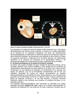 67
Figura 81 Angina de esfuerzo estable. Derivaciones aVL, I, V5 y V6
Los pacientes con angina de esfuerzo estable suelen presentar una o más placas
ateroscleróticas que reducen la luz coronaria. La angina es el reflejo sintomático
de la isquemia de un segmento miocárdico; por tanto, las modificaciones
electrocardiográficas se observarán en diferentes grupos de derivaciones según el
área miocárdica afectada: las derivaciones que exploran la cara inferior en casos
de isquemia secundaria a estenosis de la coronaria derecha, las derivaciones
anteriores en la isquemia por estenosis de la descendente anterior y las
derivaciones laterales en la isquemia secundaria a afectación de la circunfleja.
b.- El electrocardiograma en la angina de esfuerzo inestable
Se define como angina inestable una gran variedad de situaciones clínicas. Se ha
acordado clasificar como angina inestable a toda aquélla que ha cambiado de
características recientemente, de forma habitual en el último mes. Como es fácil
comprender, es muy diferente el pronóstico y el tratamiento de un paciente con
angina de esfuerzo, que se ha intensificado recientemente, del de otro con
episodios frecuentes de angina de reposo acompañados de cambios
electrocardiográficos en las últimas 24 horas. Suele deberse a un incremento de la
gravedad de la enfermedad coronaria, en algunos casos a ligeros aumentos del
grado de estenosis coronaria y, en los más severos, a oclusión coronaria
transitoria, debida a una trombosis que complica un accidente de placa o a un
espasmo coronario.
Los hallazgos electrocardiográficos más frecuentes en pacientes con angina
inestable de reposo (Figuras 82 y 83), suelen ser la lesión subendocárdica, la
depresión del segmento ST, que suele ser de mayor magnitud y duración que en
 