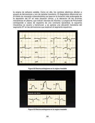 68
la angina de esfuerzo estable. Como en ella, los cambios eléctricos afectan a
grupos de derivaciones y son de carácter transitorio. El diagnóstico diferencial con
el infarto de miocardio subendocárdico se basa en la duración más prolongada de
la depresión del ST en esta situación clínica, y la elevación de las enzimas
miocárdicas en plasma, que indican necrosis de miocitos. La angina de Prinzmetal
corresponde a casos de espasmo de una coronaria epicárdica; la isquemia
miocárdica es severa y transmural, y se aprecia una elevación transitoria del
segmento ST en las derivaciones que exploran el segmento isquémico.
Figura 82 Electrocardiograma en la angina inestable
Figura 83 Electrocardiograma en la angina inestable
 