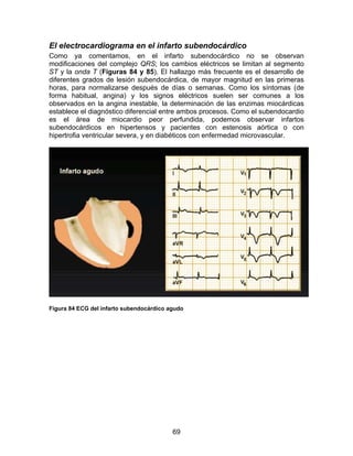 69
El electrocardiograma en el infarto subendocárdico
Como ya comentamos, en el infarto subendocárdico no se observan
modificaciones del complejo QRS; los cambios eléctricos se limitan al segmento
ST y la onda T (Figuras 84 y 85). El hallazgo más frecuente es el desarrollo de
diferentes grados de lesión subendocárdica, de mayor magnitud en las primeras
horas, para normalizarse después de días o semanas. Como los síntomas (de
forma habitual, angina) y los signos eléctricos suelen ser comunes a los
observados en la angina inestable, la determinación de las enzimas miocárdicas
establece el diagnóstico diferencial entre ambos procesos. Como el subendocardio
es el área de miocardio peor perfundida, podemos observar infartos
subendocárdicos en hipertensos y pacientes con estenosis aórtica o con
hipertrofia ventricular severa, y en diabéticos con enfermedad microvascular.
Figura 84 ECG del infarto subendocárdico agudo
 