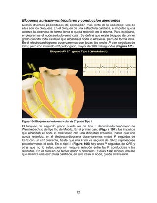 82
Bloqueos aurículo-ventriculares y conducción aberrantes
Existen diversas posibilidades de conducción más lenta de la esperada: una de
ellas son los bloqueos. En el bloqueo de una estructura cardíaca, el impulso que la
alcanza la atraviesa de forma lenta o queda retenido en la misma. Para explicarlo,
emplearemos el nodo aurículo-ventricular. Se define que existe bloqueo de primer
grado cuando todo estímulo que alcanza el nodo lo atraviesa, pero de forma lenta.
En el electrocardiograma observaremos que todas las ondas P van seguidas de
QRS, pero con intervalo PR prolongado, mayor de 200 milisegundos (Figura 103).
Figura 104 Bloqueo auriculoventricular de 2º grado Tipo I
El bloqueo de segundo grado puede ser de tipo I, denominado fenómeno de
Wenckebach, o de tipo II o de Mobitz. En el primer caso (Figura 104), los impulsos
que alcanzan el nodo lo atraviesan con una dificultad creciente, hasta que uno
queda retenido; en el electrocardiograma observaremos ondas P seguidas de
QRS con un PR creciente, hasta que una P no va seguida de QRS, repitiéndose
posteriormente el ciclo. En el tipo II (Figura 105) hay unas P seguidas de QRS y
otras que no lo están, pero sin ninguna relación entre las P conducidas y las
retenidas. En el bloqueo de tercer grado o completo (Figura 106) ningún impulso
que alcanza una estructura cardíaca, en este caso el nodo, puede atravesarla.
 