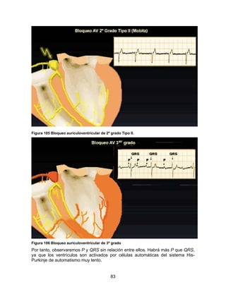 83
Figura 105 Bloqueo auriculoventricular de 2º grado Tipo II.
Figura 106 Bloqueo auriculoventricular de 3º grado
Por tanto, observaremos P y QRS sin relación entre ellos. Habrá más P que QRS,
ya que los ventrículos son activados por células automáticas del sistema His-
Purkinje de automatismo muy lento.
 