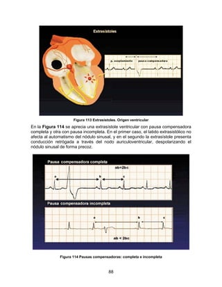 88
Figura 113 Extrasístoles. Origen ventricular
En la Figura 114 se aprecia una extrasístole ventricular con pausa compensadora
completa y otra con pausa incompleta. En el primer caso, el latido extrasistólico no
afecta al automatismo del nódulo sinusal, y en el segundo la extrasístole presenta
conducción retrógada a través del nodo auriculoventricular, despolarizando el
nódulo sinusal de forma precoz.
Figura 114 Pausas compensadoras: completa e incompleta
 