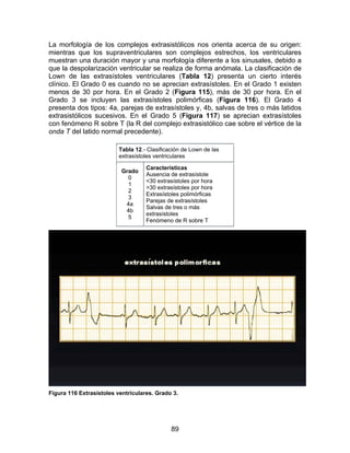 89
La morfología de los complejos extrasistólicos nos orienta acerca de su origen:
mientras que los supraventriculares son complejos estrechos, los ventriculares
muestran una duración mayor y una morfología diferente a los sinusales, debido a
que la despolarización ventricular se realiza de forma anómala. La clasificación de
Lown de las extrasístoles ventriculares (Tabla 12) presenta un cierto interés
clínico. El Grado 0 es cuando no se aprecian extrasístoles. En el Grado 1 existen
menos de 30 por hora. En el Grado 2 (Figura 115), más de 30 por hora. En el
Grado 3 se incluyen las extrasístoles polimórficas (Figura 116). El Grado 4
presenta dos tipos: 4a, parejas de extrasístoles y, 4b, salvas de tres o más latidos
extrasistólicos sucesivos. En el Grado 5 (Figura 117) se aprecian extrasístoles
con fenómeno R sobre T (la R del complejo extrasistólico cae sobre el vértice de la
onda T del latido normal precedente).
Tabla 12.- Clasificación de Lown de las
extrasístoles ventriculares
Grado
0
1
2
3
4a
4b
5
Características
Ausencia de extrasístole
<30 extrasístoles por hora
>30 extrasístoles por hora
Extrasístoles polimórficas
Parejas de extrasístoles
Salvas de tres o más
extrasístoles
Fenómeno de R sobre T
Figura 116 Extrasístoles ventriculares. Grado 3.
 