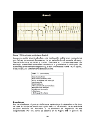 90
Figura 117 Extrasístoles ventriculares. Grado 5.
Aunque no existe acuerdo absoluto, esta clasificación podría tener implicaciones
pronósticas, aumentando la gravedad de las extrasístoles al aumentar el grado.
Son arritmias muy frecuentes y pueden observarse en corazones normales; sin
embargo, su densidad aumenta en relación con la gravedad de la cardiopatía. No
suelen requerir tratamiento específico y, si son sintomáticas (Tabla 13), se optará,
si es posible, por un tratamiento betabloqueante.
Tabla 13.- Extrasístoles
Significado clínico:
• La arritmia más frecuente
• 50% en relación con patología
cardiovascular
Sintomatología:
• Frecuentemente asintomáticas
• Palpitaciones aisladas
• Vuelco en el corazón
• Pinchazos
• Dolor pugnitivo fugaz
Parasístoles
Las parasístoles se originan en un foco que se descarga sin dependencia del ritmo
de base. La activación ventricular a partir del foco parasistólico dependerá de la
situación eléctrica del miocardio, si se encuentra en disposición de ser
despolarizado. Por ello, como se observa en la Figura 118, el período de
 