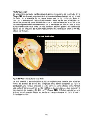 92
Flutter auricular
Es una arritmia auricular rápida producida por un mecanismo de reentrada. En la
Figura 120 se observa un esquema de ambas aurículas activadas por un círculo
de flutter; en la mayoría de los casos posee una vía de conducción lenta en
dirección craneo-caudal y otra rápida caudo-craneal, de la que se desprenden
frentes de activación para despolarizar toda la masa miocárdica auricular. Este
circuito despolariza las aurículas entre 200 y 300 veces por minuto, pero el nodo
auriculoventricular actúa como un filtro eléctrico, dejando pasar a los ventrículos
alguno de los impulsos del flutter (habitualmente los ventrículos laten a 100-150
latidos por minuto).
Figura 120 Activación auricular en el flutter
En esta arritmia, la despolarización auricular originará unas ondas F o de flutter en
forma de dientes de sierra; los complejos QRS serán estrechos, ya que la
conducción, una vez que atraviesa el nodo, activa los ventrículos de forma normal.
Las ondas F serán negativas y más visibles en las derivaciones que exploran la
cara inferior del corazón: DII, DIII y aVF (Figura 121). El flutter auricular es una
arritmia poco frecuente. Suele ser inestable, transformándose en ritmo sinusal o
fibrilación auricular.
 