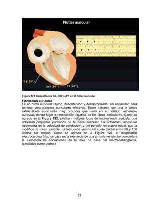 93
Figura 121 Derivaciones DII, DIII y aVF en el flutter auricular
Fibrilación auricular
Es un ritmo auricular rápido, desordenado y desincronizado, sin capacidad para
generar contracciones auriculares efectivas. Suele iniciarse por una o varias
extrasístoles auriculares muy precoces que caen en el período vulnerable
auricular, dando lugar a reexcitación repetida de las fibras auriculares. Como se
aprecia en la Figura 122, existirán múltiples focos de microentrada auricular que
activarán pequeñas porciones de la masa auricular. La activación ventricular
dependerá de la velocidad de conducción y del periodo refractario nodal, que la
modifica de forma variable. La frecuencia ventricular suele oscilar entre 90 y 150
latidos por minuto. Como se aprecia en la Figura 123, el diagnóstico
electrocardiográfico se basa en la existencia de una arritmia ventricular completa y
la existencia de oscilaciones en la línea de base del electrocardiograma,
conocidas como ondas f.
 