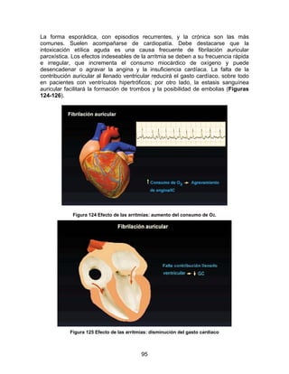 95
La forma esporádica, con episodios recurrentes, y la crónica son las más
comunes. Suelen acompañarse de cardiopatía. Debe destacarse que la
intoxicación etílica aguda es una causa frecuente de fibrilación auricular
paroxística. Los efectos indeseables de la arritmia se deben a su frecuencia rápida
e irregular, que incrementa el consumo miocárdico de oxígeno y puede
desencadenar o agravar la angina y la insuficiencia cardíaca. La falta de la
contribución auricular al llenado ventricular reducirá el gasto cardíaco, sobre todo
en pacientes con ventrículos hipertróficos; por otro lado, la estasis sanguínea
auricular facilitará la formación de trombos y la posibilidad de embolias (Figuras
124-126).
Figura 124 Efecto de las arritmias: aumento del consumo de O2.
Figura 125 Efecto de las arritmias: disminución del gasto cardíaco
 