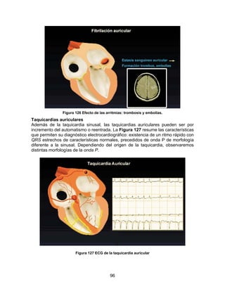 96
Figura 126 Efecto de las arritmias: trombosis y embolias.
Taquicardias auriculares
Además de la taquicardia sinusal, las taquicardias auriculares pueden ser por
incremento del automatismo o reentrada. La Figura 127 resume las características
que permiten su diagnóstico electrocardiográfico: existencia de un ritmo rápido con
QRS estrechos de características normales, precedidos de onda P de morfología
diferente a la sinusal. Dependiendo del origen de la taquicardia, observaremos
distintas morfologías de la onda P.
Figura 127 ECG de la taquicardia auricular
 