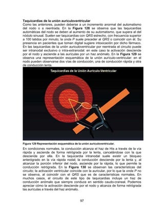 97
Taquicardias de la unión auriculoventricular
Como las anteriores, pueden deberse a un incremento anormal del automatismo
del nodo o a reentrada. En la Figura 128 se observa que las taquicardias
automáticas del nodo se deben al aumento de su automatismo, que supera al del
nódulo sinusal. Suelen ser taquicardias con QRS estrecho, con frecuencia superior
a 100 latidos por minuto; la onda P suele preceder al QRS o coincidir con él. Su
presencia en pacientes que toman digital sugiere intoxicación por dicho fármaco.
En las taquicardias de la unión auriculoventricular por reentrada el circuito puede
ser intranodal exclusivo o intra-extranodal: en este caso la activación desciende
por el nodo y asciende a las aurículas por un haz anómalo. En la Figura 129 se
observa una representación esquemática de la unión aurículo-ventricular: en el
nodo pueden observarse dos vías de conducción, una de conducción rápida y otra
de conducción lenta.
Figura 129 Representación esquemática de la unión auriculoventricular.
En condiciones normales, la conducción alcanza el haz de His a través de la vía
rápida y asciende de forma retrógrada por la lenta, cancelándose con la que
desciende por ella. En la taquicardia intranodal suele existir un bloqueo
anterógrado en la vía rápida nodal; la conducción desciende por la lenta y, al
alcanzar la porción inferior del nodo, asciende por la rápida, lo que permite la
conducción retrógrada. En la Figura 130 se observan las características del
circuito; la activación ventricular coincide con la auricular, por lo que la onda P no
se observa, al coincidir con el QRS que es de características normales. En
muchos casos, el circuito de este tipo de taquicardias incluye un haz de
conducción anómalo que siempre conduce en sentido caudo-craneal. Podemos
apreciar cómo la activación desciende por el nodo y alcanza de forma retrógrada
las aurículas a través del haz anómalo.
 