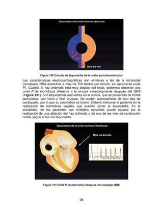 98
Figura 130 Circuito de taquicardia de la unión auriculoventricular
Las características electrocardiográficas son similares a las de la intranodal
(complejos QRS estrechos a más de 150 latidos por minuto, sin apreciarse onda
P). Cuando el haz anómalo está muy alejado del nodo, podemos observar una
onda P de morfología diferente a la sinusal inmediatamente después del QRS
(Figura 131). Son taquicardias frecuentes en la clínica, que se presentan de forma
paroxística, con inicio y final bruscos. No suelen acompañarse de otro tipo de
cardiopatía, por lo que su pronóstico es bueno. Deberá instruirse al paciente en la
realización de maniobras vagales que puedan cortar la taquicardia. En la
actualidad, en los pacientes con múltiples episodios puede optarse por la
realización de una ablación del haz anómalo o de una de las vías de conducción
nodal, según el tipo de taquicardia.
Figura 131 Onda P característica después del complejo QRS
 