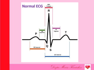Normal ECG
 