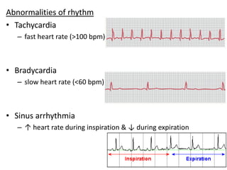 Abnormalities of rhythm
• Tachycardia
– fast heart rate (>100 bpm)
• Bradycardia
– slow heart rate (<60 bpm)
• Sinus arrhythmia
– ↑ heart rate during inspiration & ↓ during expiration
 