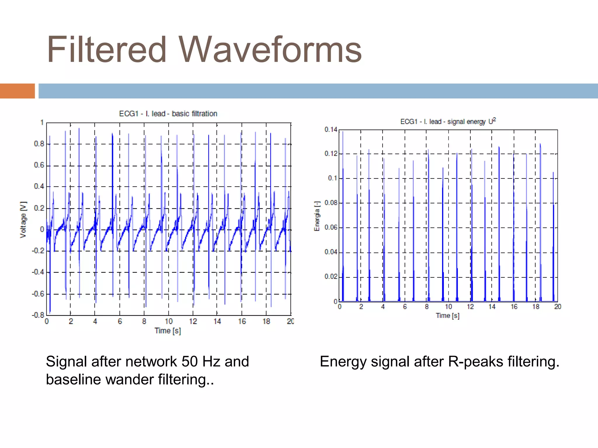 Filtered Waveforms

Signal after network 50 Hz and
baseline wander filtering..

Energy signal after R-peaks filtering.

 
