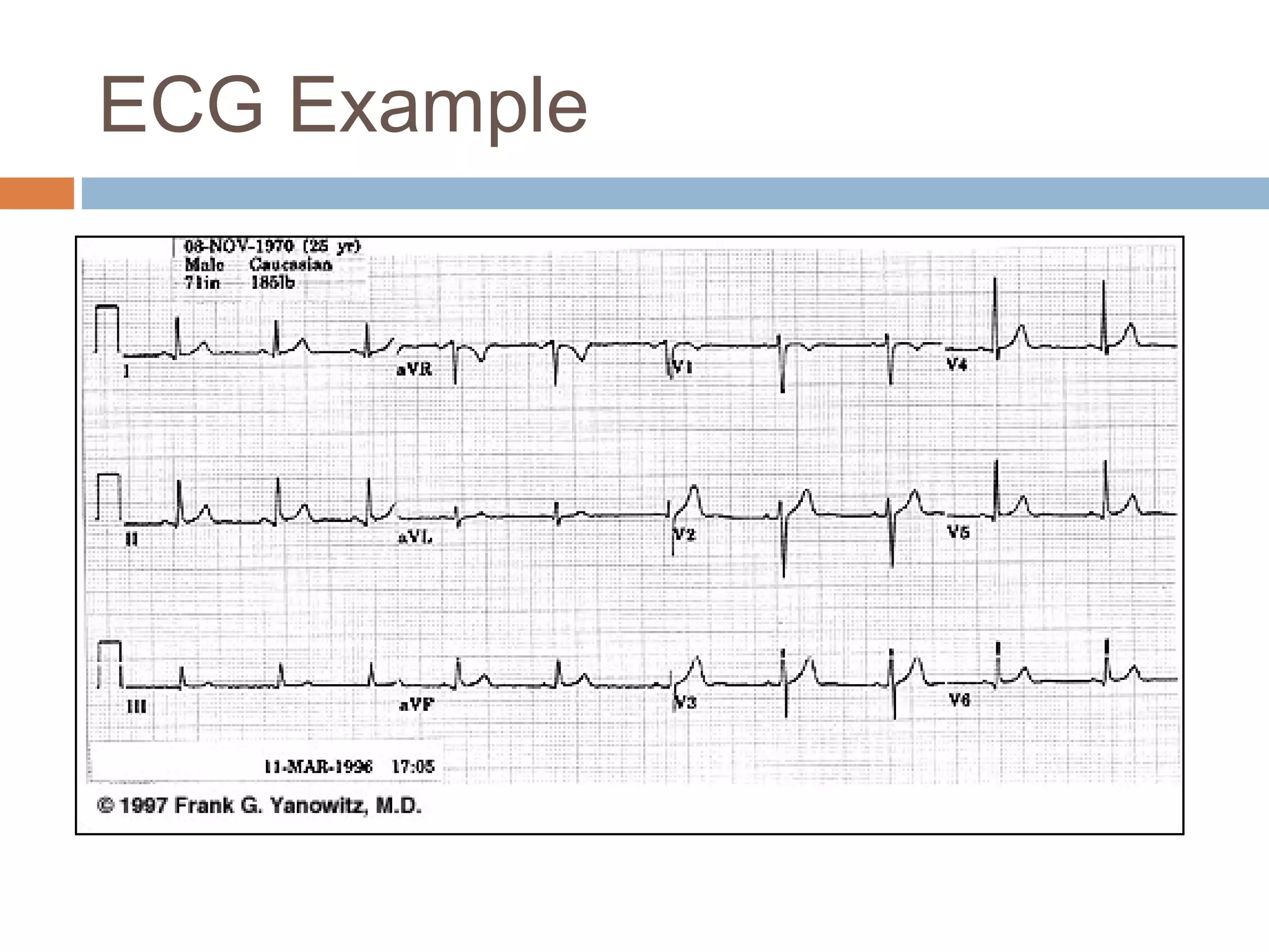 ECG Example

 