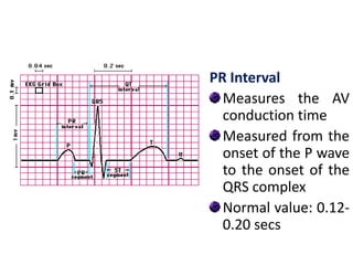 PR Interval
Measures the AV
conduction time
Measured from the
onset of the P wave
to the onset of the
QRS complex
Normal value: 0.12-
0.20 secs
 