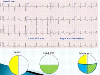Lead I Lead aVF Mean axis
 