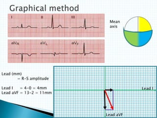 Lead (mm)
= R-S amplitude
Lead I = 4-0 = 4mm
Lead aVF = 13-2 = 11mm
Lead I
Lead aVF
Mean
axis
 