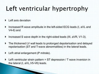  Left axis deviation
 Increased R wave amplitude in the left-sided ECG leads (I, aVL and
V4-6) and
 Increased S wave depth in the right-sided leads (III, aVR, V1-3).
 The thickened LV wall leads to prolonged depolarisation and delayed
repolarisation (ST and T-wave abnormalities) in the lateral leads.
 Left atrial enlargement (P mitrale).
 Left ventricular strain pattern = ST depression / T wave inversion in
the lateral (I, aVL,V5-V6) leads.
 