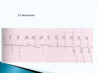 ST depression
 