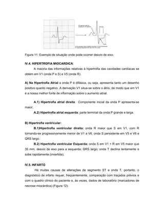 Figura 11: Exemplo de situação onde pode ocorrer desvio de eixo.
IV.4. HIPERTROFIA MIOCARDICA:
A maioria das informações relativas à hipertrofia das cavidades cardíacas se
obtém em V1 (onda P e S) e V5 (onda R).
A) Na Hipertrofia Atrial a onda P é difásica, ou seja, apresenta tanto um desenho
positivo quanto negativo. A derivação V1 situa-se sobre o átrio, de modo que em V1
é a nossa melhor fonte de informação sobre o aumento atrial.
A.1) Hipertrofia atrial direita: Componente inicial da onda P apresenta-se
maior;
A.2) Hipertrofia atrial esquerda: parte terminal da onda P grande e larga.
B) Hipertrofia ventricular:
B.1)Hipertrofia ventricular direita: onda R maior que S em V1, com R
tornando-se progressivamente menor de V1 a V6; onda S persistente em V5 e V6 e
QRS largo.
B.2) Hipertrofia ventricular Esquerda: onda S em V1 + R em V5 maior que
35 mm; desvio de eixo para a esquerda; QRS largo; onda T declina lentamente e
sobe rapidamente (invertida).
IV.5. INFARTO
Há muitas causas de alterações de segmento ST e onda T, portanto, o
diagnóstico de infarto requer, freqüentemente, comparação com traçados prévios e
com o quadro clínico do paciente e, às vezes, dados de laboratório (marcadores de
necrose miocárdica) (Figura 12).
 