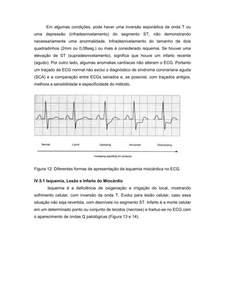 Em algumas condições, pode haver uma inversão esporádica da onda T ou
uma depressão (infradesnivelamento) do segmento ST, não demonstrando
necessariamente uma anormalidade. Infradesnivelamento do tamanho de dois
quadradinhos (2mm ou 0,08seg.) ou mais é considerado isquemia. Se houver uma
elevação de ST (supradesnivelamento), significa que houve um infarto recente
(agudo). Por outro lado, algumas anomalias cardíacas não alteram o ECG. Portanto
um traçado de ECG normal não exclui o diagnóstico de síndrome coronariana aguda
(SCA) e a comparação entre ECGs seriados e, se possível, com traçados antigos,
melhora a sensibilidade e especificidade do método.
Figura 12: Diferentes formas de apresentação da isquemia miocárdica no ECG.
IV.5.1 Isquemia, Lesão e Infarto do Miocárdio
Isquemia é a deficiência de oxigenação e irrigação do local, mostrando
sofrimento celular, com inversão da onda T. Evolui para lesão celular, caso essa
situação não seja revertida, com desníveis no segmento ST. Infarto é a morte celular
em um determinado ponto ou conjunto de tecidos (necrose) e traduz-se no ECG com
o aparecimento de ondas Q patológicas (Figura 13 e 14).
 