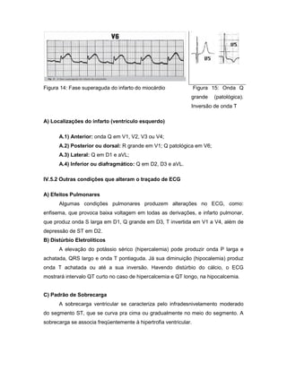 Figura 14: Fase superaguda do infarto do miocárdio Figura 15: Onda Q
grande (patológica).
Inversão de onda T
A) Localizações do infarto (ventrículo esquerdo)
A.1) Anterior: onda Q em V1, V2, V3 ou V4;
A.2) Posterior ou dorsal: R grande em V1; Q patológica em V6;
A.3) Lateral: Q em D1 e aVL;
A.4) Inferior ou diafragmático: Q em D2, D3 e aVL.
IV.5.2 Outras condições que alteram o traçado de ECG
A) Efeitos Pulmonares
Algumas condições pulmonares produzem alterações no ECG, como:
enfisema, que provoca baixa voltagem em todas as derivações, e infarto pulmonar,
que produz onda S larga em D1, Q grande em D3, T invertida em V1 a V4, além de
depressão de ST em D2.
B) Distúrbio Eletrolíticos
A elevação do potássio sérico (hipercalemia) pode produzir onda P larga e
achatada, QRS largo e onda T pontiaguda. Já sua diminuição (hipocalemia) produz
onda T achatada ou até a sua inversão. Havendo distúrbio do cálcio, o ECG
mostrará intervalo QT curto no caso de hipercalcemia e QT longo, na hipocalcemia.
C) Padrão de Sobrecarga
A sobrecarga ventricular se caracteriza pelo infradesnivelamento moderado
do segmento ST, que se curva pra cima ou gradualmente no meio do segmento. A
sobrecarga se associa freqüentemente à hipertrofia ventricular.
 
